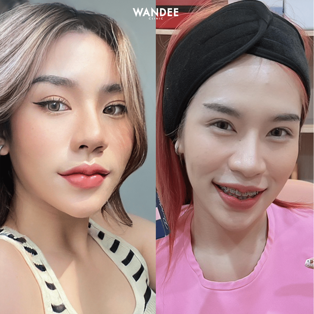 ทรงปากกระจับ