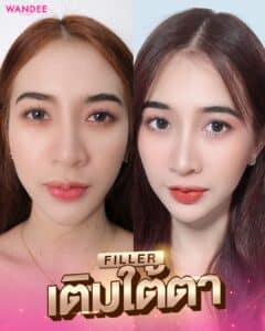 ฟิลเลอร์