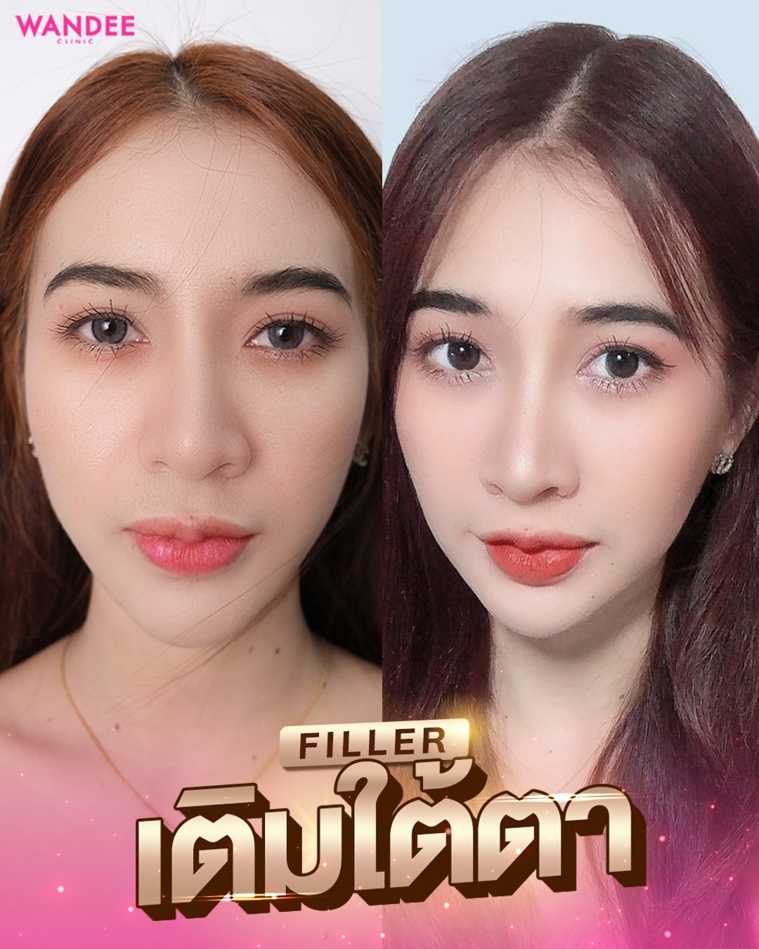 ฟิลเลอร์
