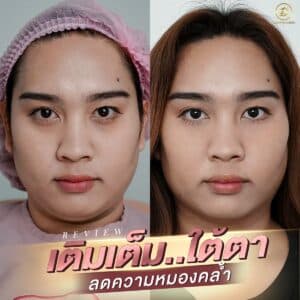 ฟิลเลอร์