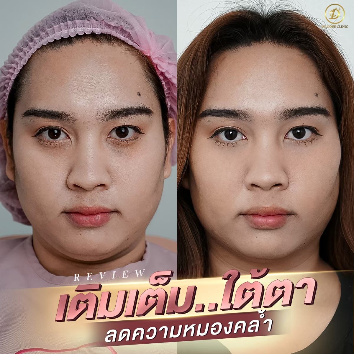ฟิลเลอร์