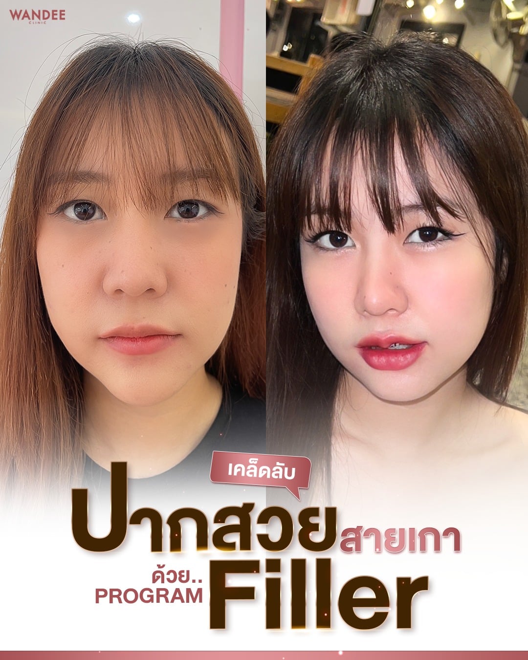 ฟิลเลอร์